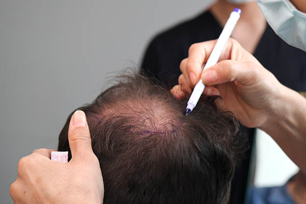 How to Select a Donor Area for Hair Transplant