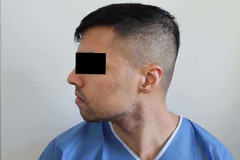 Beard Transplant Before & After Image