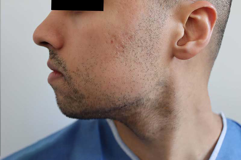 Beard Transplant Before & After Image